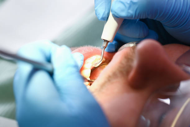 Best Emergency Dentist for Lost Fillings or Crowns in Eagle Mountain, UT