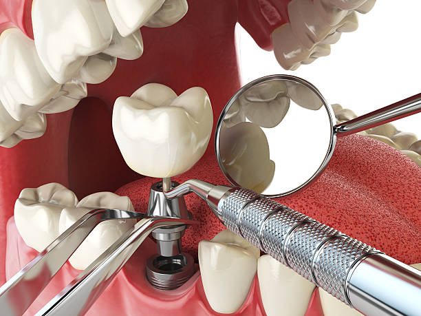 Best Emergency Dental Extractions in Eagle Mountain, UT